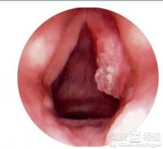 咽喉癌症状及表现 咽喉癌的症状 咽喉癌有哪些表现