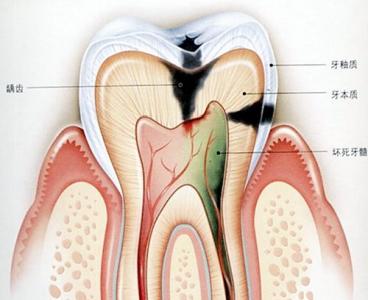 急性牙髓炎夜里怎么办 牙髓炎怎么办啊