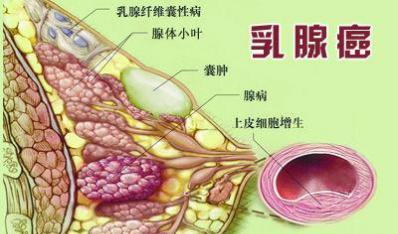 上海最好男性医院 乳腺疾病的症状有哪些