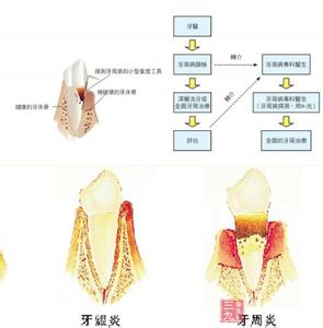 牙周病的局部促进因素 牙周病学 引起牙周病的因素有哪些