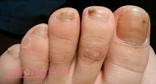 脚灰指甲图片 脚灰指甲的治疗方法