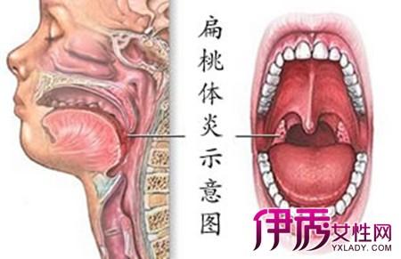 扁桃体发炎的症状图片 扁桃体发炎症状