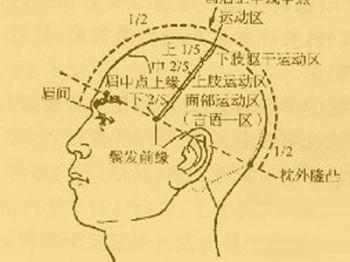 治疗脑梗塞的偏方 脑梗塞偏方 怎样有效治疗脑梗塞（16）