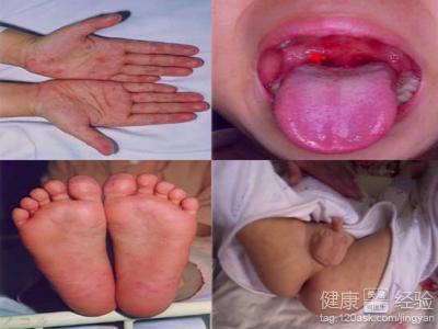 儿童手足口病初期症状 儿童手足口病 几种手足口病症状得重视