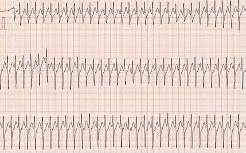 心动过速会猝死吗 心动过速怎么办