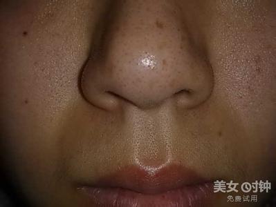 缩小毛孔7个实用方法 怎样使鼻子毛孔变小
