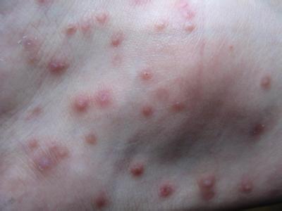 怎么治疗过敏性皮肤病 花粉过敏性皮肤病怎么治疗