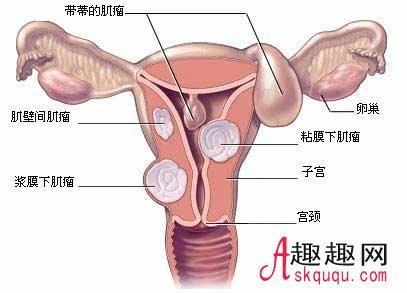 子宫肌瘤会不会癌变 子宫肌瘤严重吗