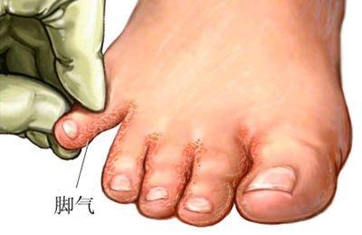 怎样治疗脚气脚臭 怎样治疗脚臭 治好你的脚气