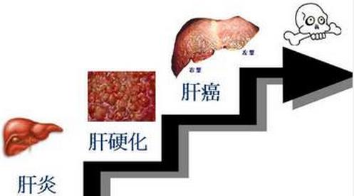 肝硬化什么症状晚期 肝硬化什么症状 正确认识肝硬化症状