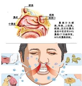 过敏性鼻炎能治愈吗 过敏性鼻炎怎么治疗