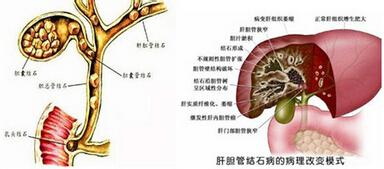 肝内胆管结石长的快吗 肝内胆管结石饮食
