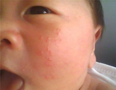 湿疹有哪些症状 湿疹的症状是什么