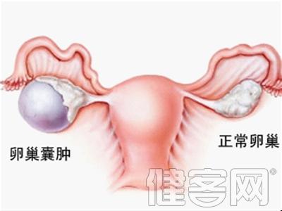 卵巢囊肿 卵巢囊肿的原因 女士要预防不得不知的6个方面
