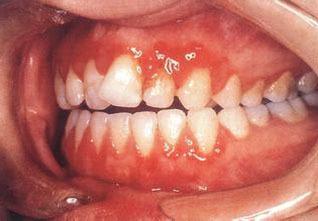 牙龈炎的治疗方法 牙龈炎怎么办 牙龈炎的治疗方法有哪些