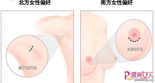 韩式隆胸 韩式隆胸 韩式隆胸-概念，韩式隆胸-主要特色
