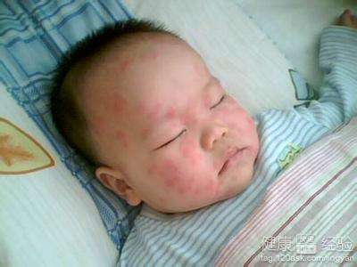 小儿荨麻疹的食疗膳方 小儿荨麻疹的实用食疗