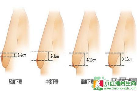 乳房下垂是什么原因 乳房下垂 乳房下垂的原因是什么