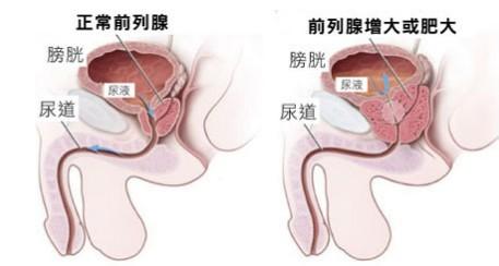 前列腺肥大吃什么药 前列腺肥大的症状