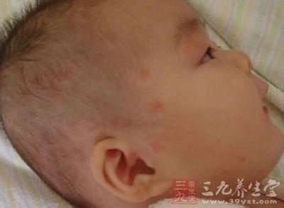 婴儿湿疹怎么治疗 婴儿湿疹怎么办 婴儿湿疹怎么治疗