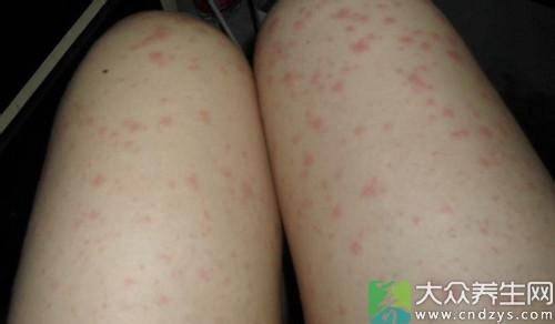 大腿根部出现小红点 大腿根部出现这一物危险（3）