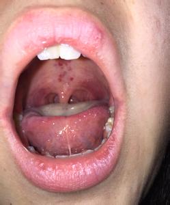 嗓子疼吃什么食物好 嗓子疼不能吃什么 15种食物伤害你的喉咙