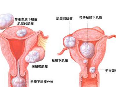 子宫肌瘤9厘米严重吗 子宫肌瘤多大算严重