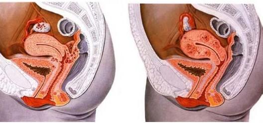 子宫腺肌症自然怀孕了 子宫腺肌症能怀孕吗