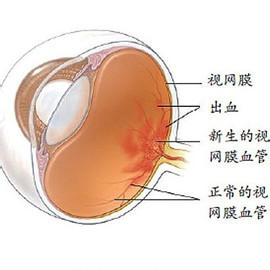 玻璃体出血症状 玻璃体出血的原因 玻璃体出血的症状与治疗