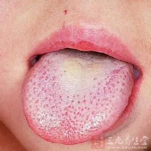 身体乏力困倦舌苔白 舌苔厚黄是怎么回事 看舌苔知身体状况（10）