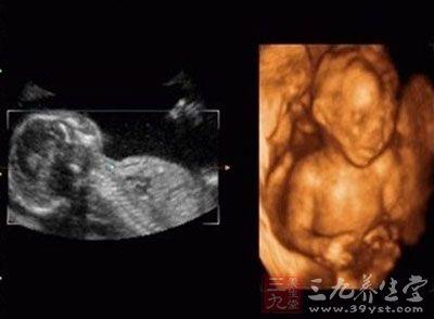 胎儿八个月四维彩超 怀孕八个月胎儿彩超 四维彩超是什么