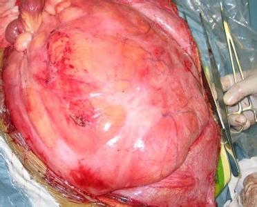 周围血管疾病的体征 肝血管肉瘤 肝血管肉瘤-疾病描述，肝血管肉瘤-症状体征