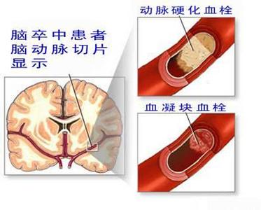 脑血栓形成原因 老年人脑血栓形成的原因 防止脑血栓形成（2）