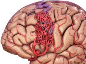 动静脉畸形 脑动静脉畸形 脑动静脉畸形-病理概述，脑动静脉畸形-症状体征