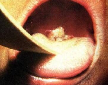 早期白喉有哪些症状 白喉病 白喉病-病因，白喉病-早期症状