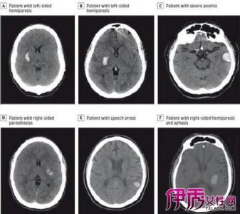 脑白质疏松症治疗 脑白质疏松症 脑白质疏松症-概念，脑白质疏松症-治疗