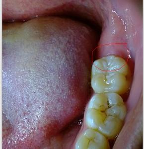 牙齿酸疼怎么治疗方法 牙齿酸疼是怎么回事
