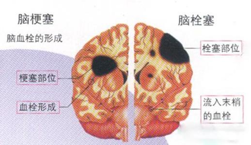 脑血栓前兆症状 脑血栓前兆 脑血栓早期的四大症状