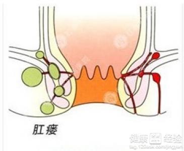 肛瘘的形成原因 肛瘘的原因 警惕六大原因形成肛瘘