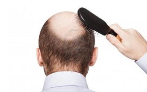 掉头发脱发 男人如何预防脱发、防止大量掉头发