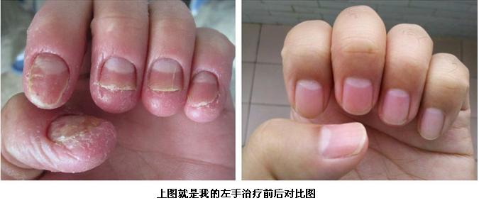 怎样能快速治好灰指甲 怎样才能治疗灰指甲