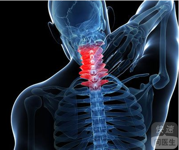 脊髓型颈椎病护理查房 脊髓型颈椎病如何进行日常护理