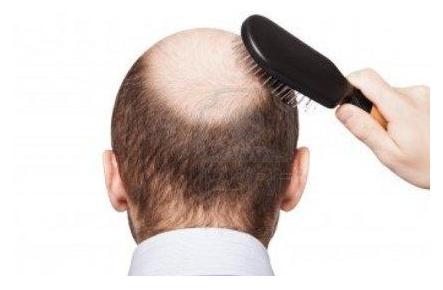 男性脱发治疗方法 男性脱发怎么办 治疗男性脱发的各种方法