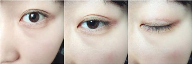 单眼皮如何变成双眼皮 单眼皮如何变成双眼皮办法