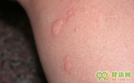 湿疹防治 湿疹是怎么引起的 了解4个因素好防治
