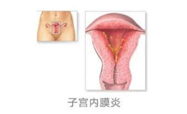 子宫内膜炎的症状 子宫内膜炎的原因 子宫内膜炎的症状与治疗