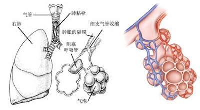 肺纤维化能治愈吗 肺纤维化是怎么回事