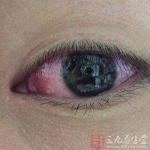 纹眼线导致的结膜炎 病毒性结膜炎患者增多 女子应少画内眼线