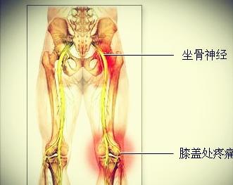 坐骨神经痛症状及治疗 坐骨神经痛症状 坐骨神经痛怎么治疗