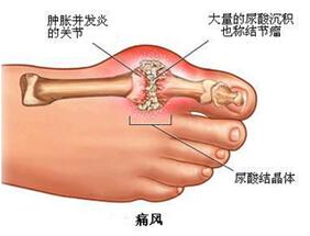 痛风吃什么食物最好 痛风症状及治疗方法